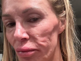Mannequin Brandi Glanville says breast implants brought about facial parasite