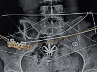 Mia Khalifa shares x-ray of her physique to ‘reclaim’ picture after leaving grownup business