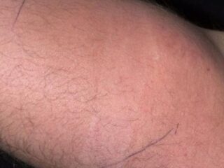 Man turns up at hospital after injecting semen into his arm for 18 months to alleviate ache
